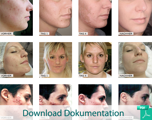 Skin Rejuvenation mit Hair & Skin IPL